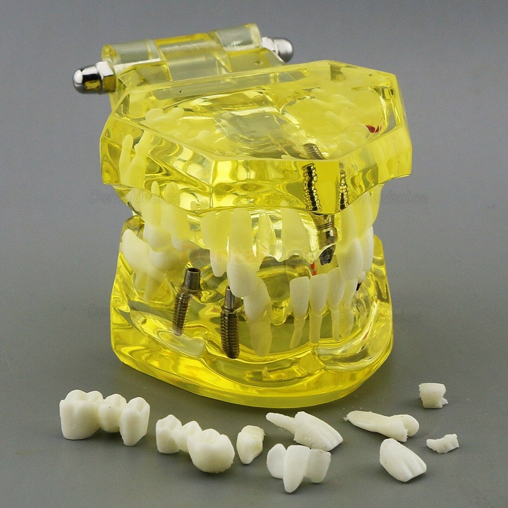 Dental Teeth Implant Model for Training Teaching Patient Education 2001 Yellow