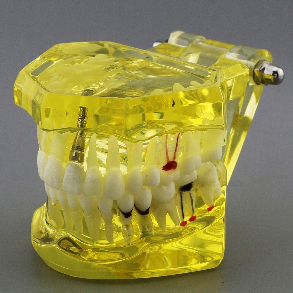 Dental Teeth Implant Model for Training Teaching Patient Education 2001 Yellow
