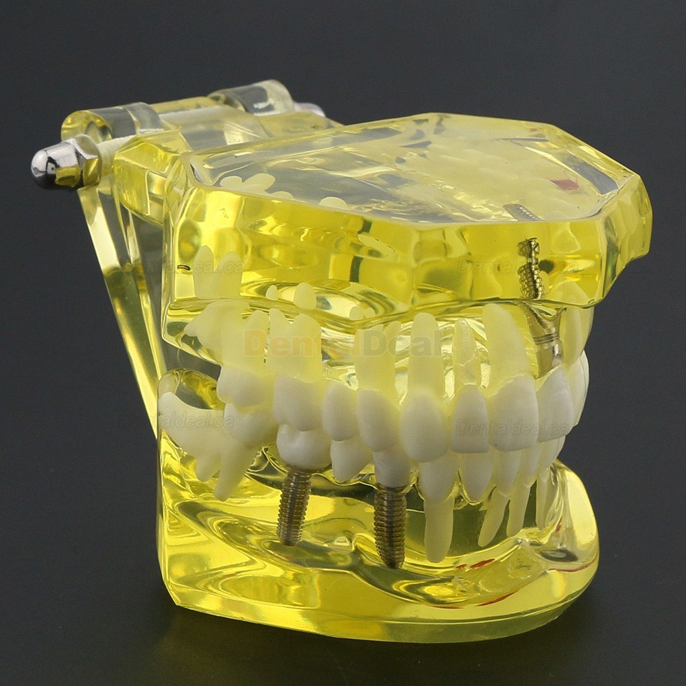 Dental Teeth Implant Model for Training Teaching Patient Education 2001 Yellow