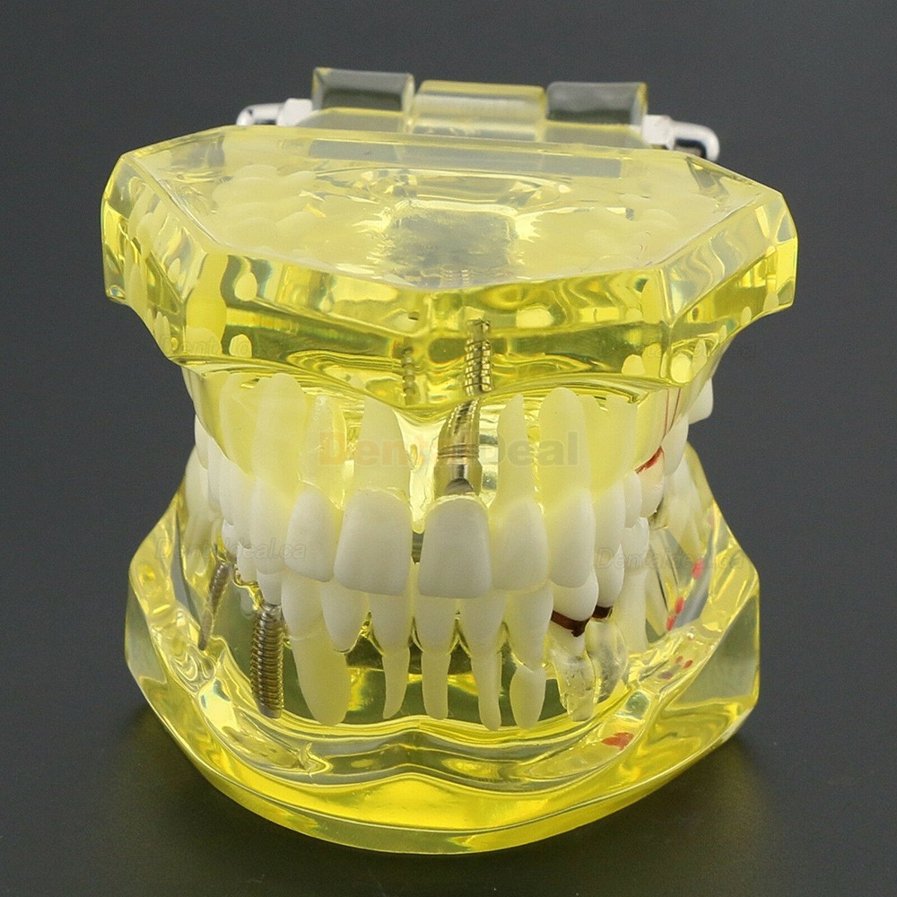 Dental Teeth Implant Model for Training Teaching Patient Education 2001 Yellow