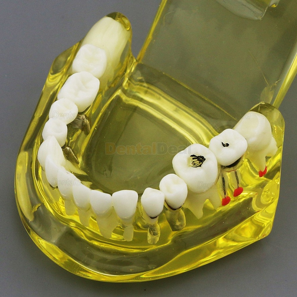 Dental Teeth Implant Model for Training Teaching Patient Education 2001 Yellow