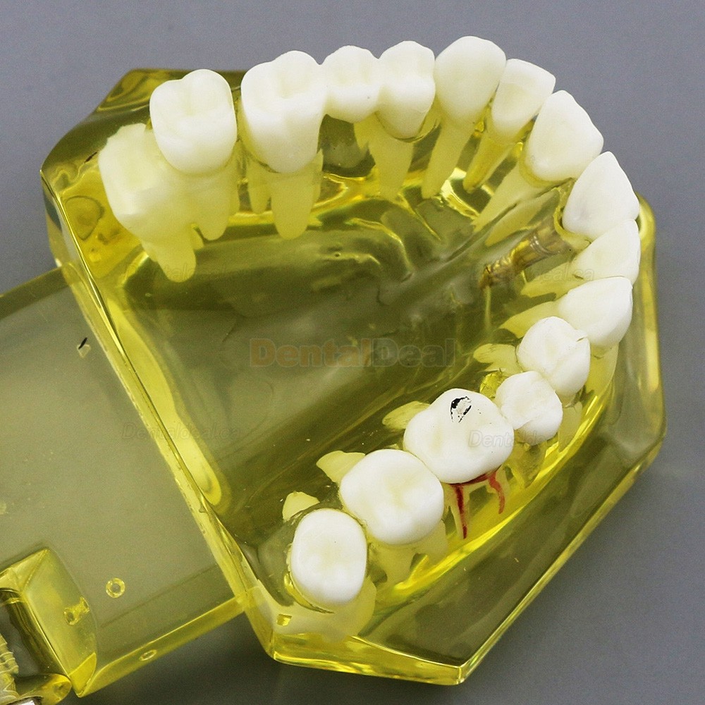 Dental Teeth Implant Model for Training Teaching Patient Education 2001 Yellow