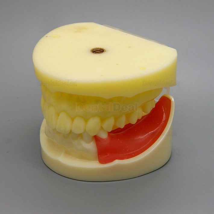 Dental Implant Practice Model with Replaceable Implant Socket 2002