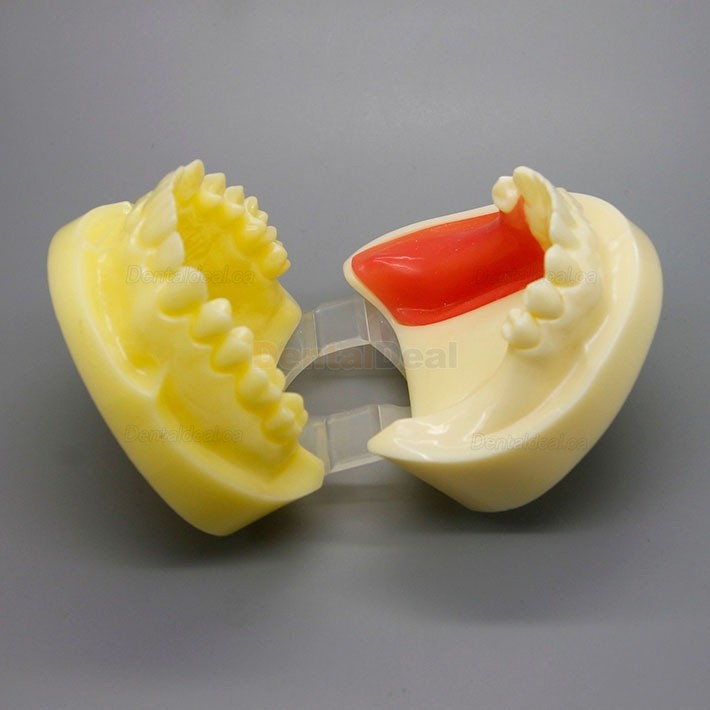Dental Implant Practice Model with Replaceable Implant Socket 2002