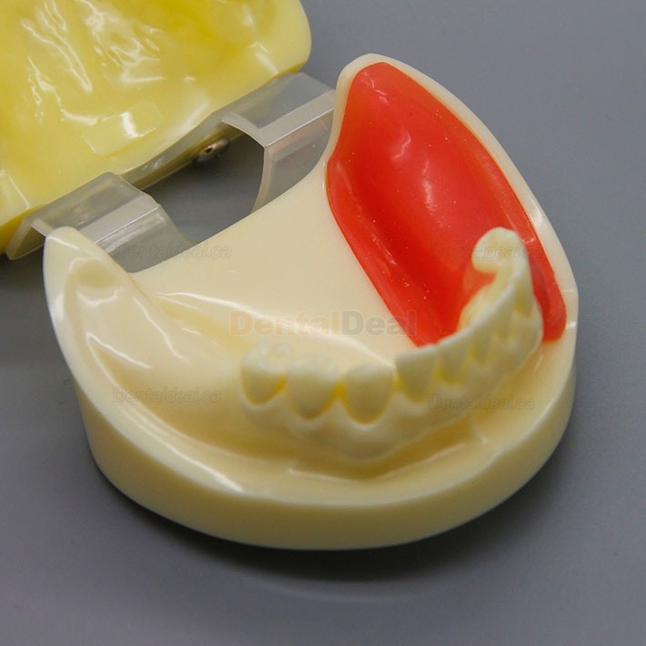 Dental Implant Practice Model with Replaceable Implant Socket 2002