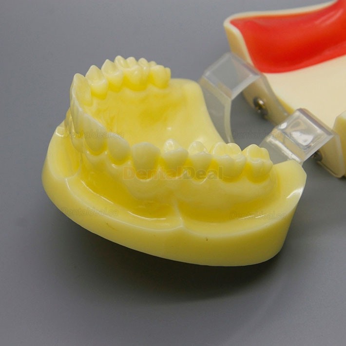 Dental Implant Practice Model with Replaceable Implant Socket 2002