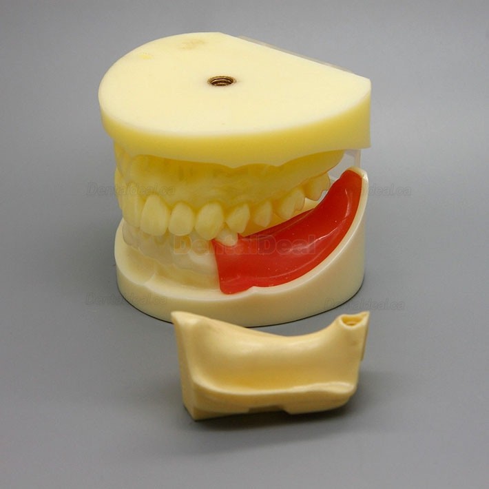 Dental Implant Practice Model with Replaceable Implant Socket 2002