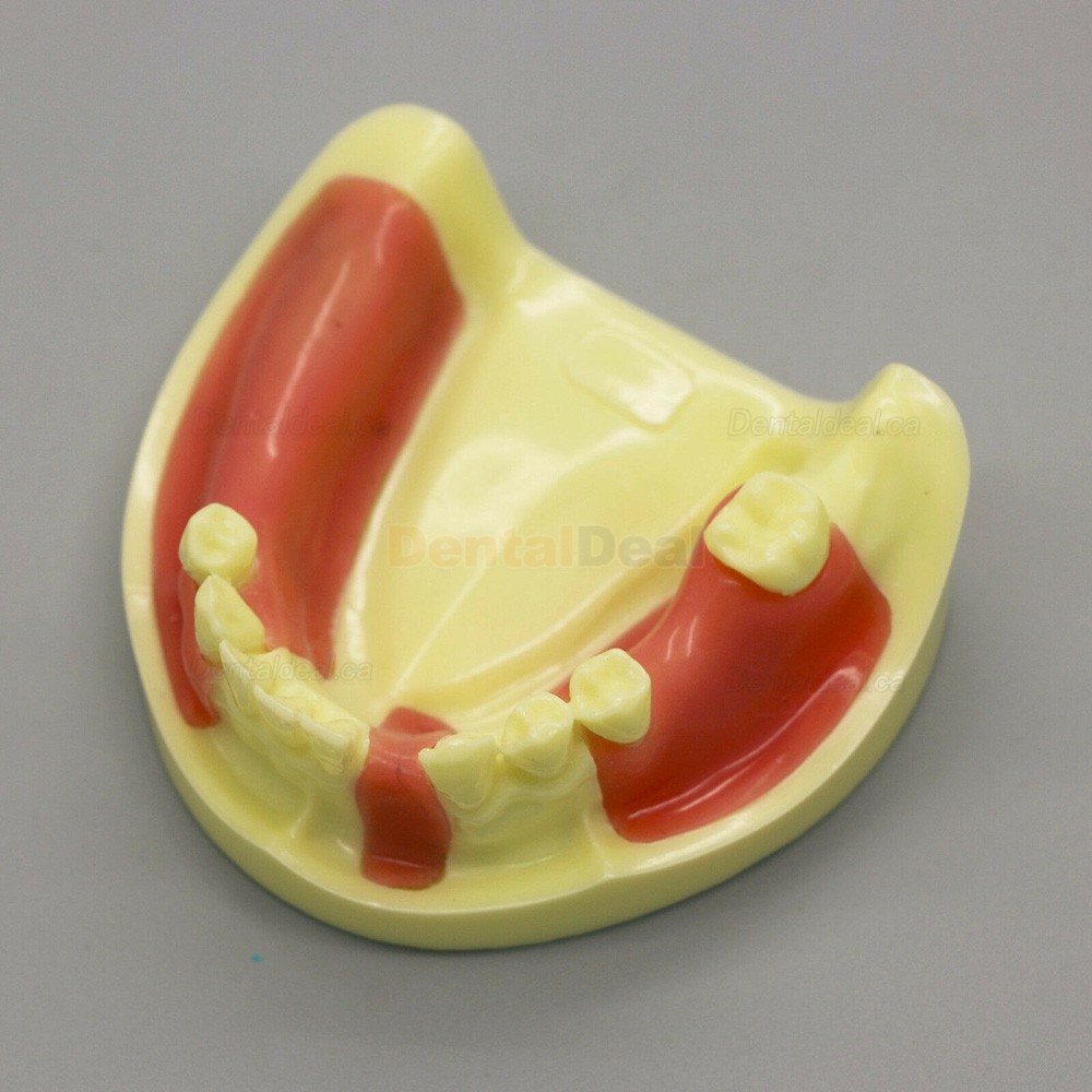 Dental Implant Model Lower Jaw Training Practice Demo Model with Gingiva #2004 01
