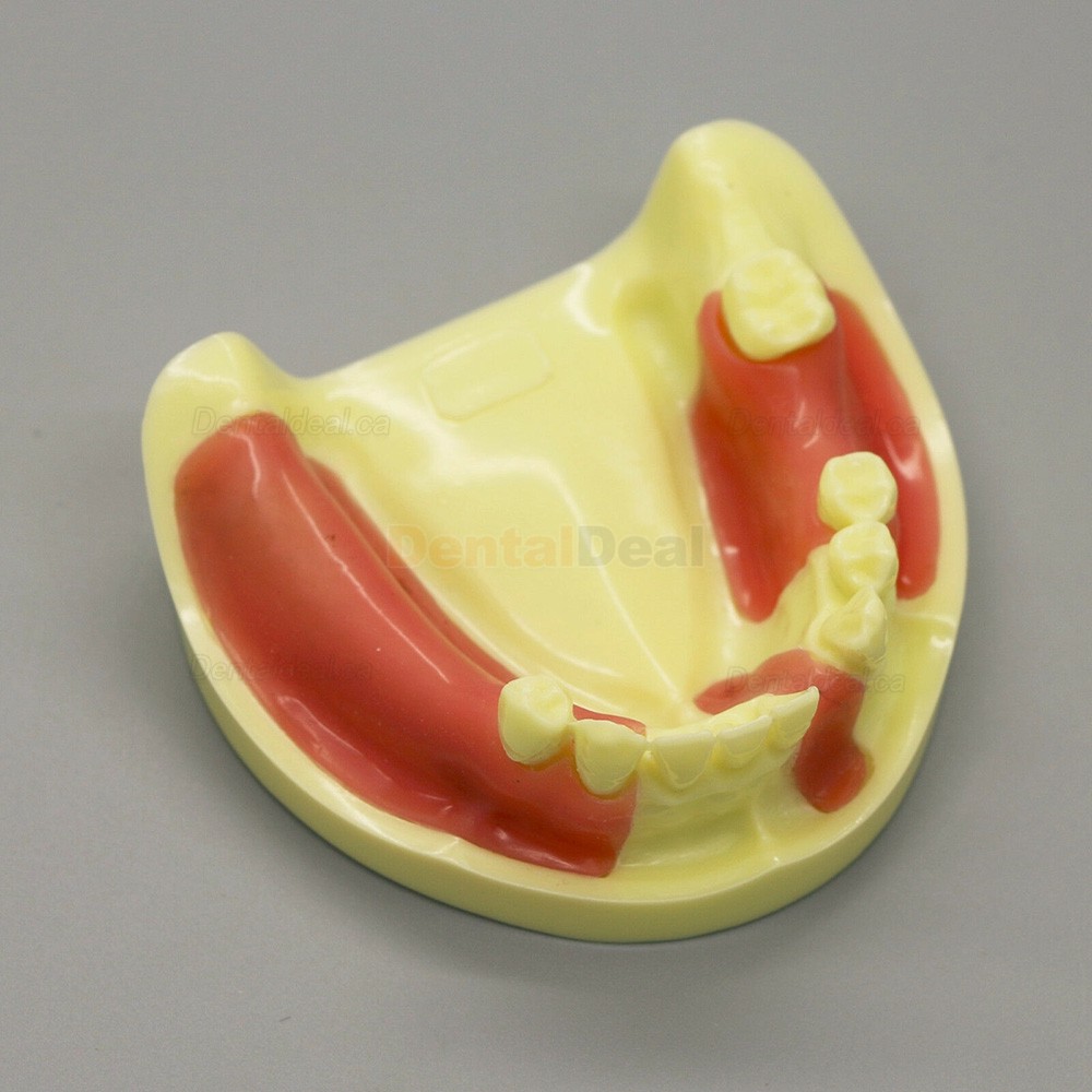Dental Implant Model Lower Jaw Training Practice Demo Model with Gingiva #2004 01
