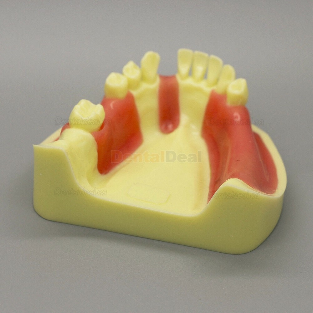Dental Implant Model Lower Jaw Training Practice Demo Model with Gingiva #2004 01
