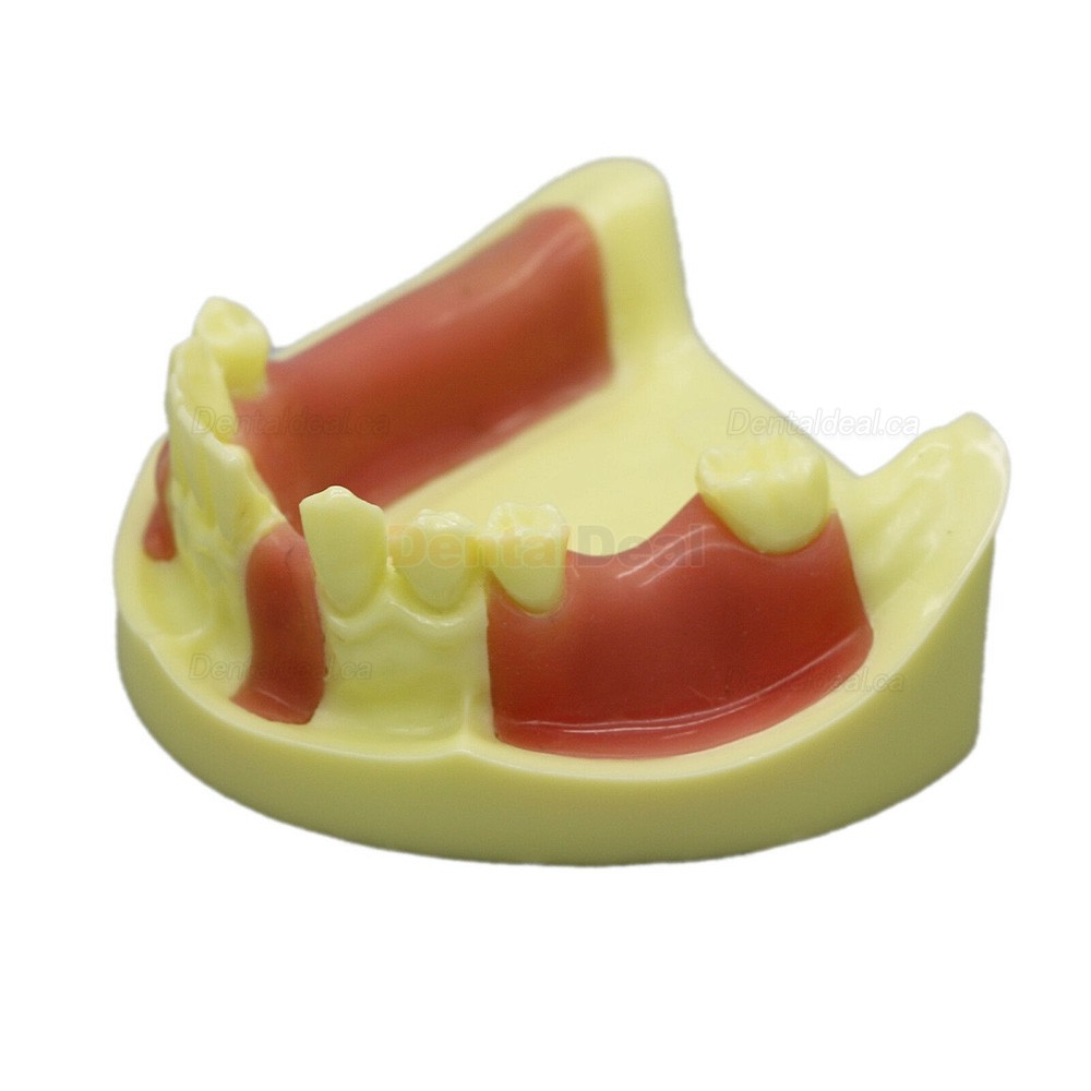 Dental Implant Model Lower Jaw Training Practice Demo Model with Gingiva #2004 01