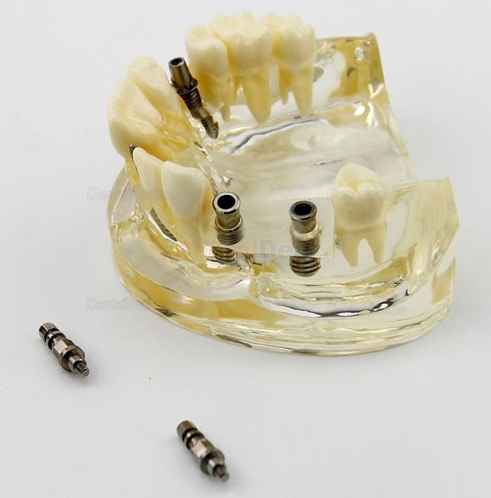 Dental Upper Jaw Implant Study Model Teaching Training Demostration 2005