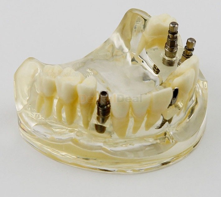 Dental Upper Jaw Implant Study Model Teaching Training Demostration 2005