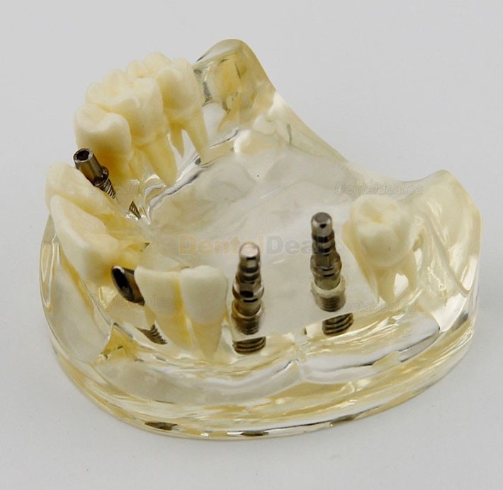 Dental Upper Jaw Implant Study Model Teaching Training Demostration 2005