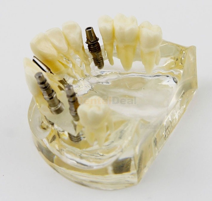 Dental Upper Jaw Implant Study Model Teaching Training Demostration 2005