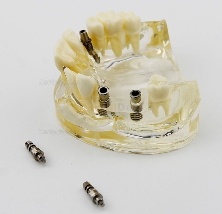 Dental Upper Jaw Implant Study Model Teaching Training Demostration 2005