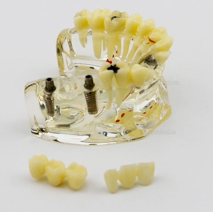Dental Upper Jaw Implant Model with Bridge and Caries Demo Study 2006