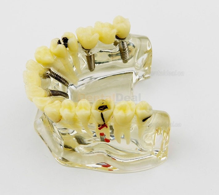 Dental Upper Jaw Implant Model with Bridge and Caries Demo Study 2006