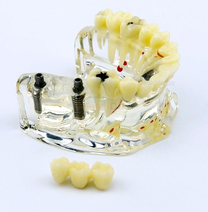Dental Upper Jaw Implant Model with Bridge and Caries Demo Study 2006