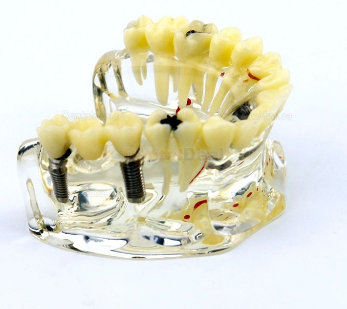 Dental Upper Jaw Implant Model with Bridge and Caries Demo Study 2006