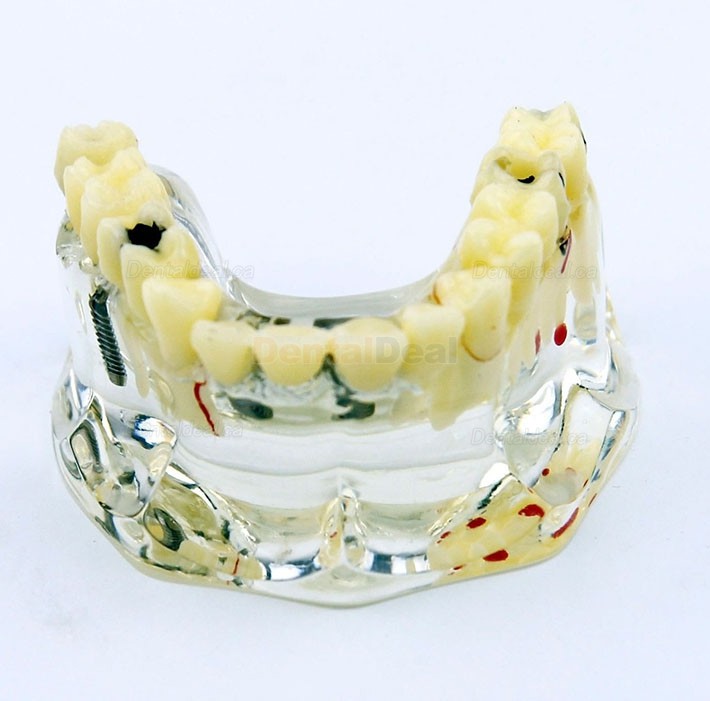 Dental Upper Jaw Implant Model with Bridge and Caries Demo Study 2006