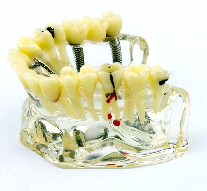 Dental Upper Jaw Implant Model with Bridge and Caries Demo Study 2006