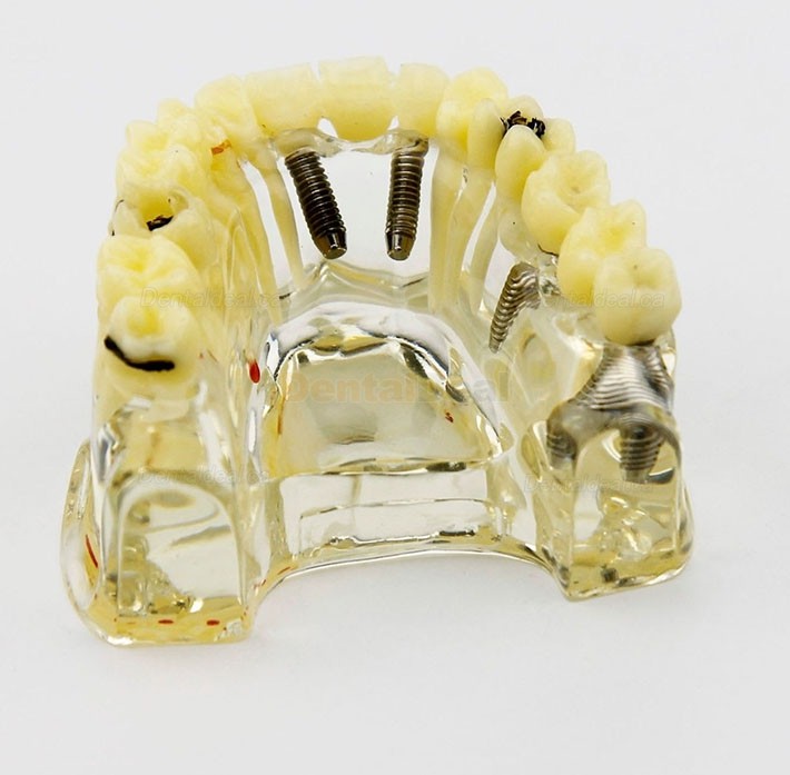 Dental Upper Jaw Implant Model with Bridge and Caries Demo Study 2006