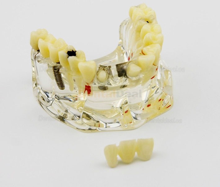 Dental Upper Jaw Implant Model with Bridge and Caries Demo Study 2006