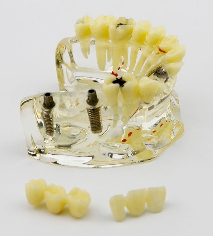 Dental Upper Jaw Implant Model with Bridge and Caries Demo Study 2006