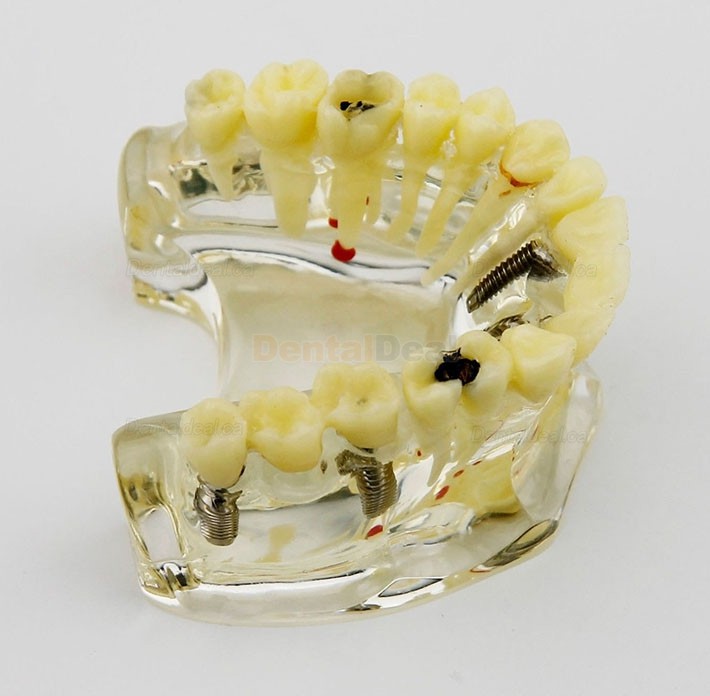 Dental Upper Jaw Implant Model with Bridge and Caries Demo Study 2006