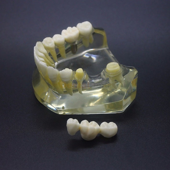 Dental Implant Study Training Demo Model Lower Jaw Crown Bridge 2010