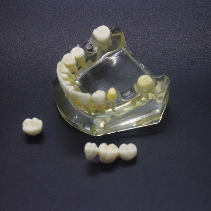 Dental Implant Study Training Demo Model Lower Jaw Crown Bridge 2010