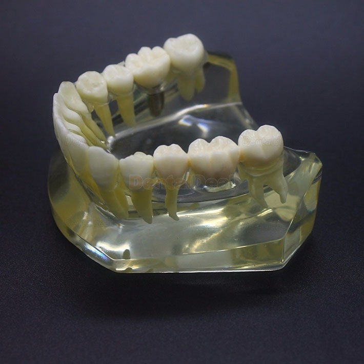 Dental Implant Study Training Demo Model Lower Jaw Crown Bridge 2010