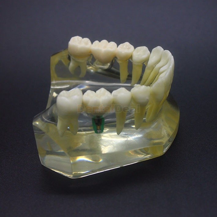 Dental Implant Study Training Demo Model Lower Jaw Crown Bridge 2010