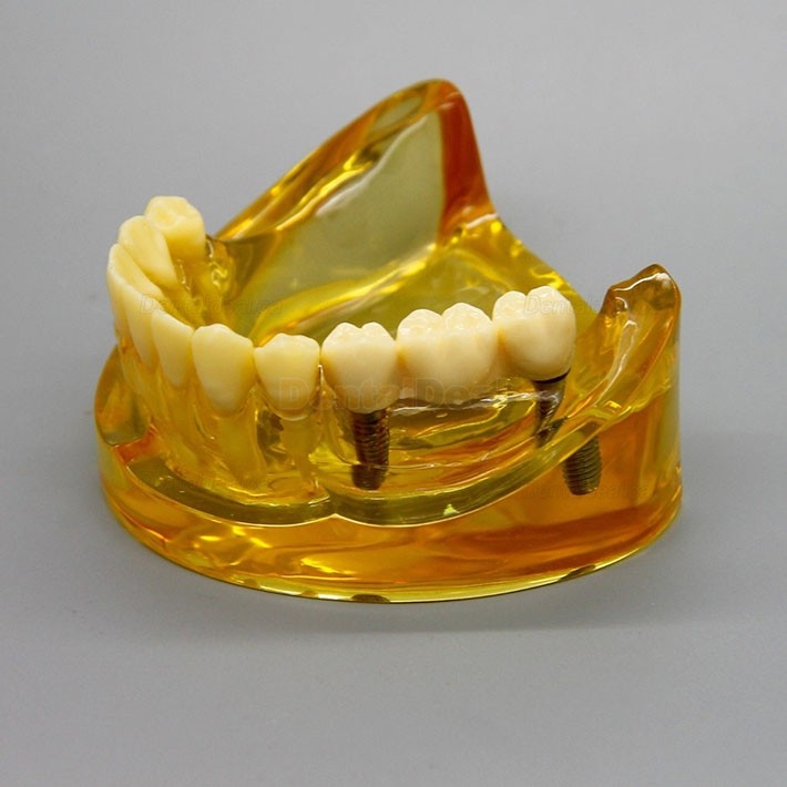 Dental Lower Jaw Implant Model with 2 Implants and Fixed Bridge 2011