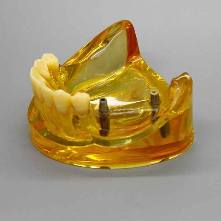 Dental Lower Jaw Implant Model with 2 Implants and Fixed Bridge 2011