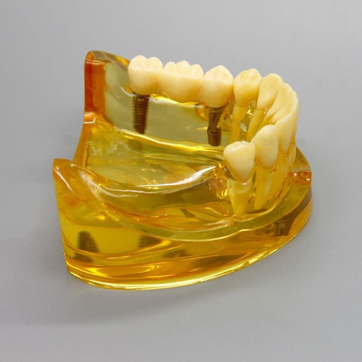 Dental Lower Jaw Implant Model with 2 Implants and Fixed Bridge 2011