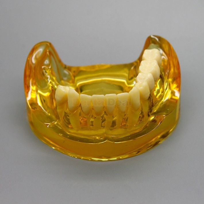 Dental Lower Jaw Implant Model with 2 Implants and Fixed Bridge 2011