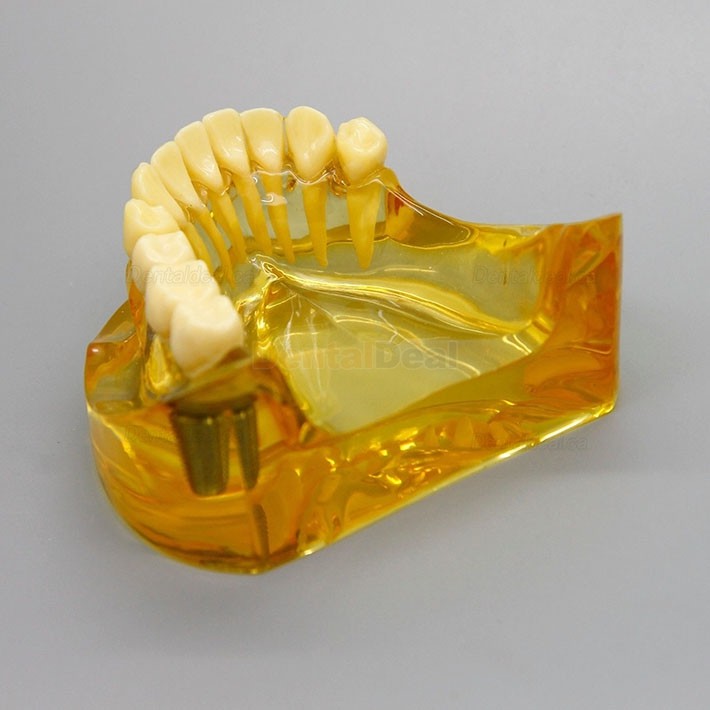Dental Lower Jaw Implant Model with 2 Implants and Fixed Bridge 2011