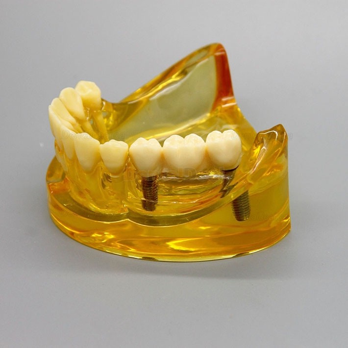 Dental Lower Jaw Implant Model with 2 Implants and Fixed Bridge 2011