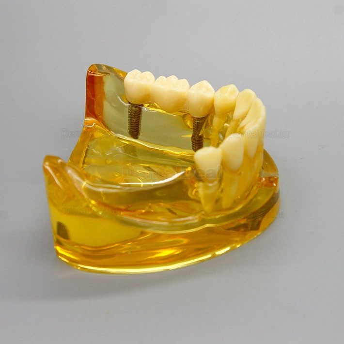 Dental Lower Jaw Implant Model with 2 Implants and Fixed Bridge 2011