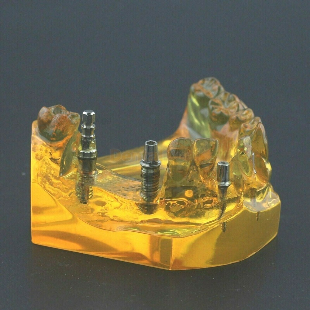 Dental Implant Typodont Teeth Model Upper Jaw Demo Model #201102