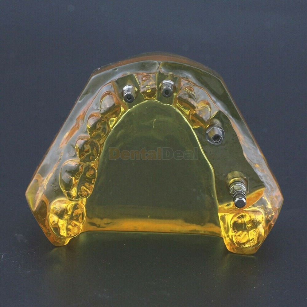 Dental Implant Typodont Teeth Model Upper Jaw Demo Model #201102