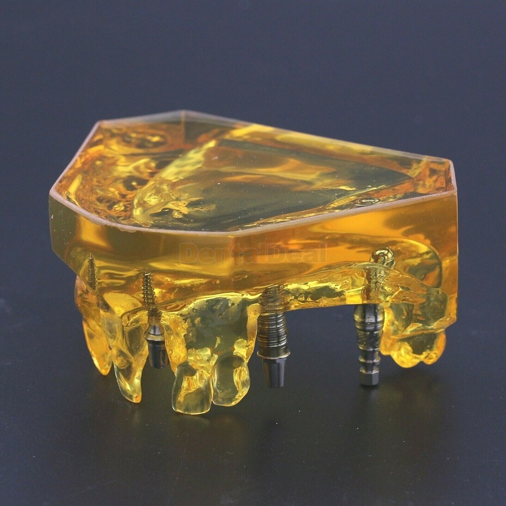 Dental Implant Typodont Teeth Model Upper Jaw Demo Model #201102