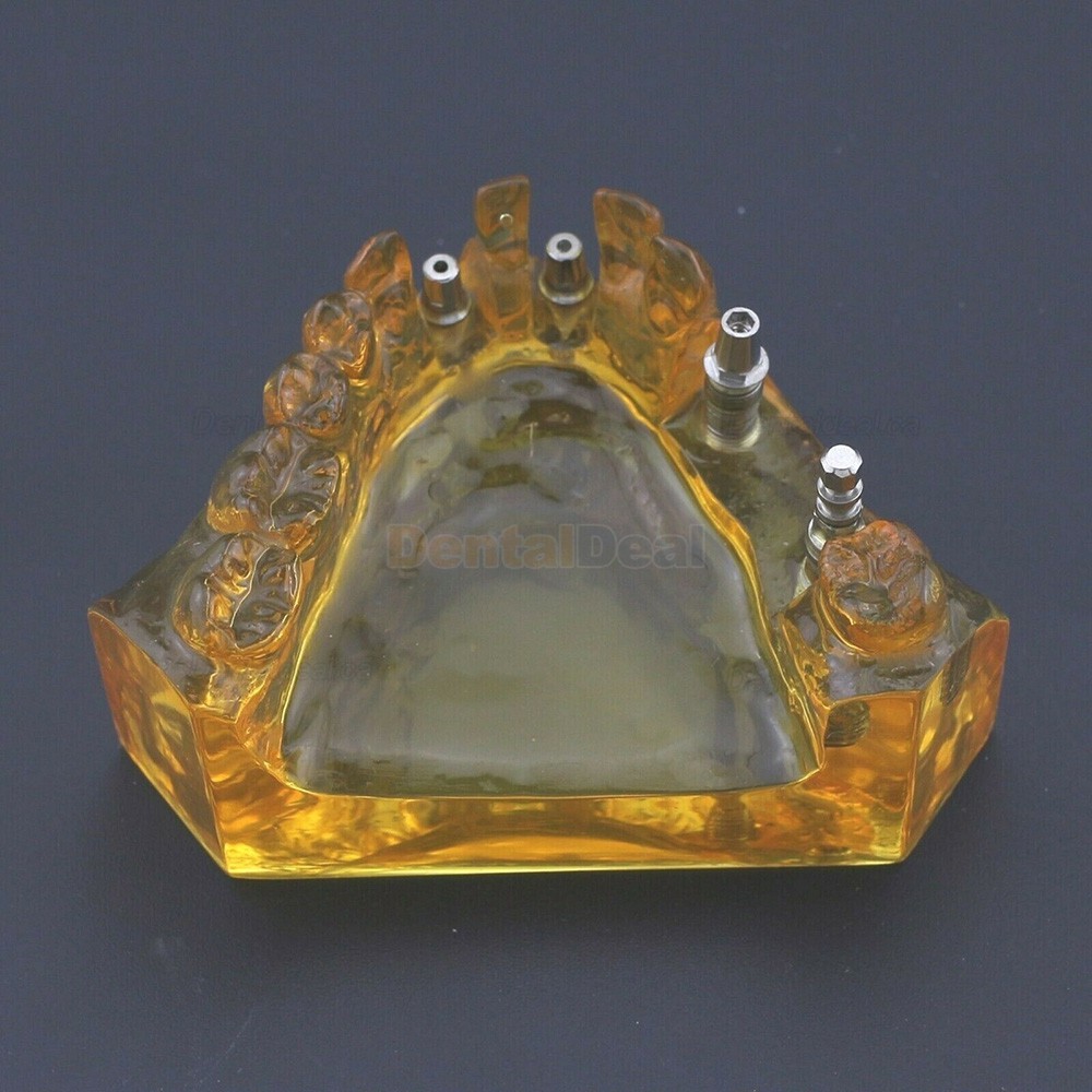 Dental Implant Typodont Teeth Model Upper Jaw Demo Model #201102