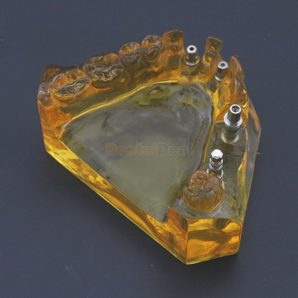 Dental Implant Typodont Teeth Model Upper Jaw Demo Model #201102