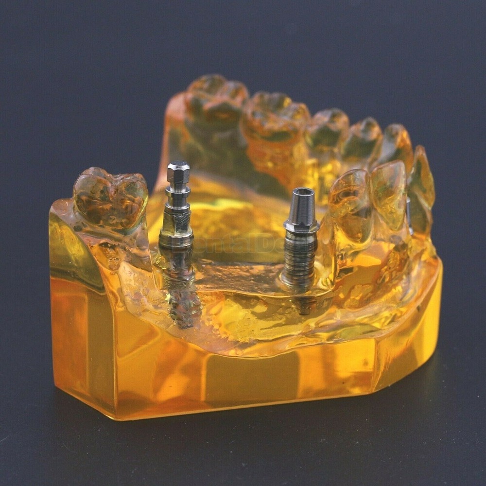 Dental Implant Typodont Teeth Model Upper Jaw Demo Model #201102