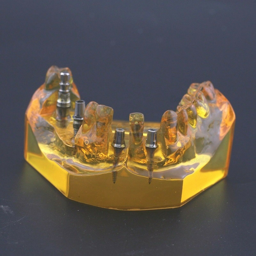 Dental Implant Typodont Teeth Model Upper Jaw Demo Model #201102