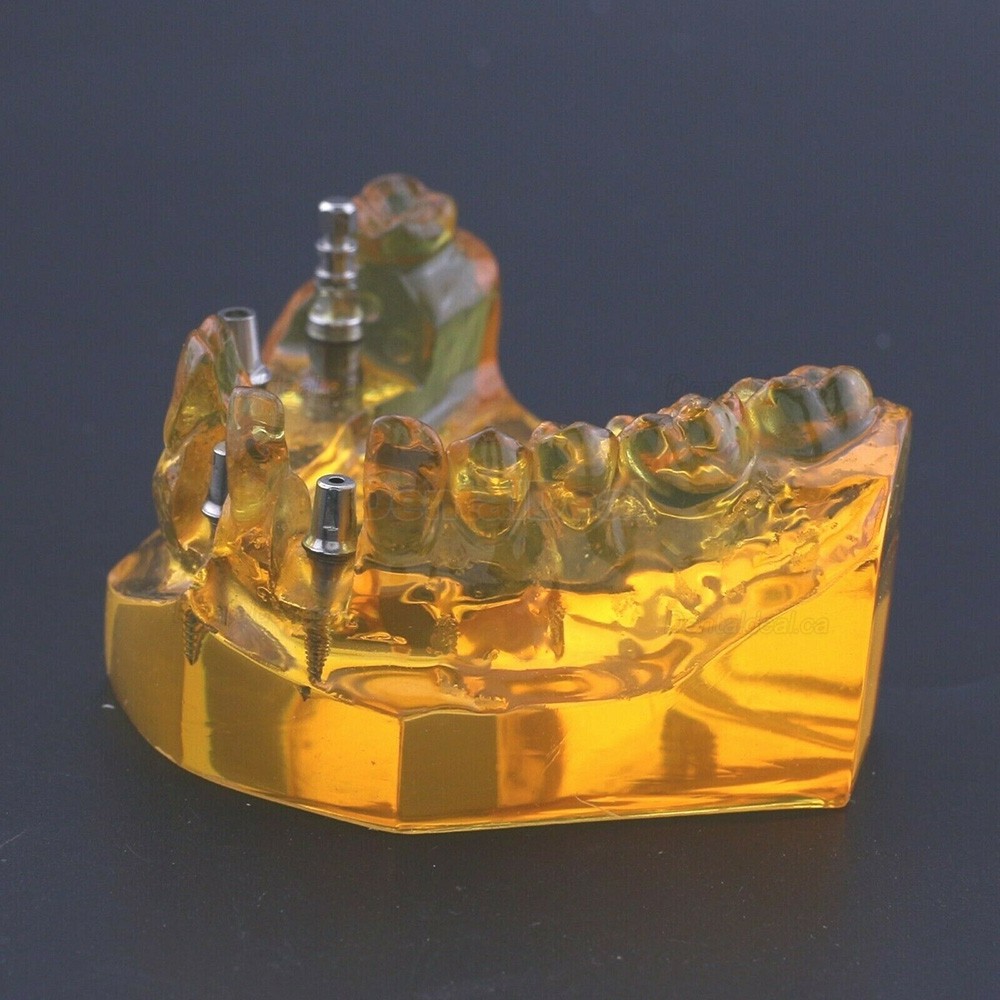 Dental Implant Typodont Teeth Model Upper Jaw Demo Model #201102