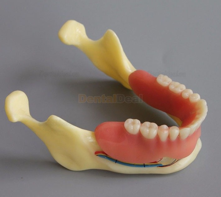 Dental Implant Overdenture Model for Study Training Demonstration #2014 02